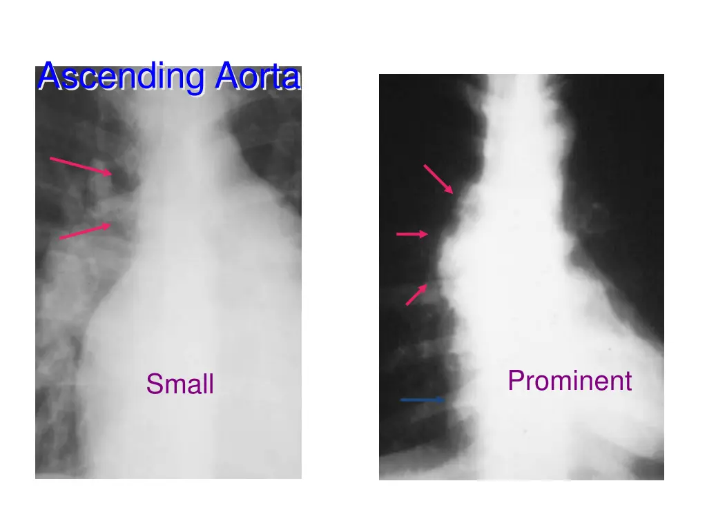 ascending aorta 1