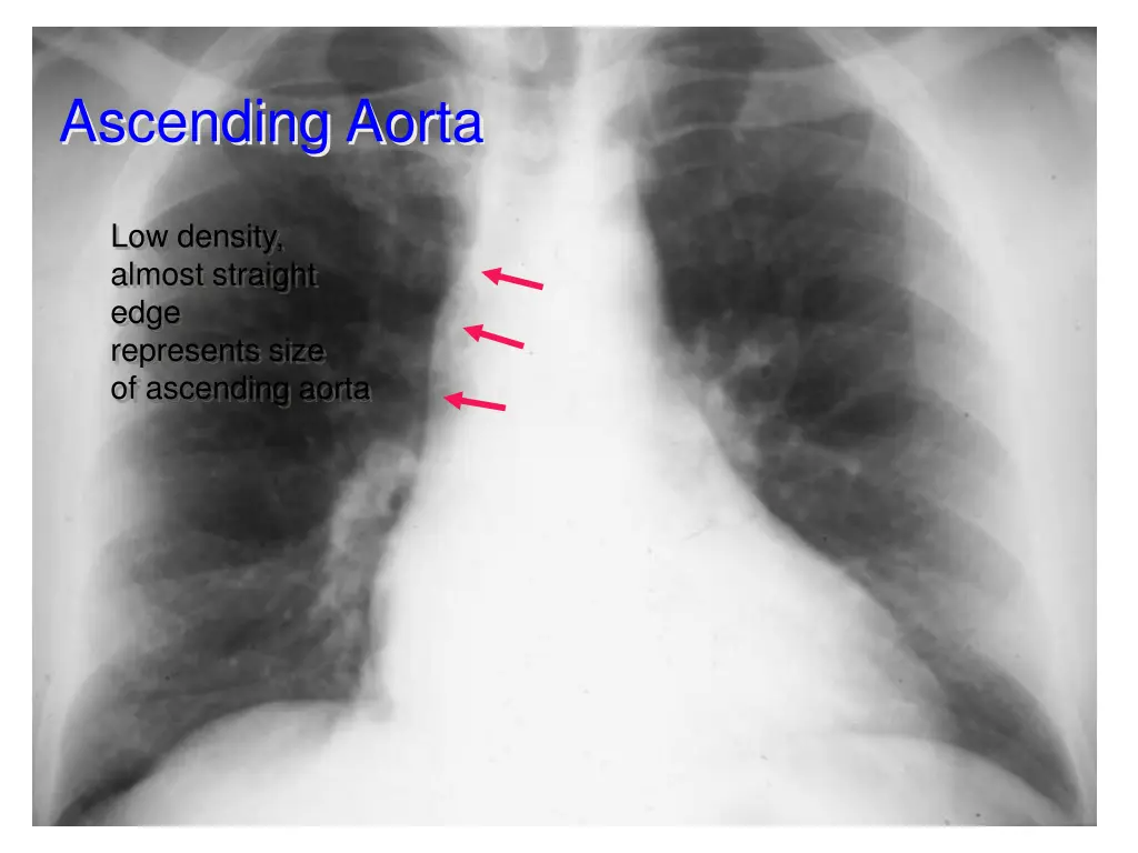 ascending aorta