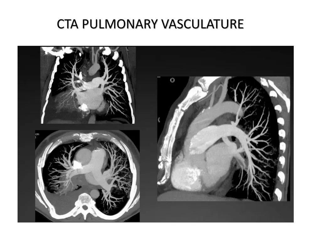 cta pulmonary vasculature