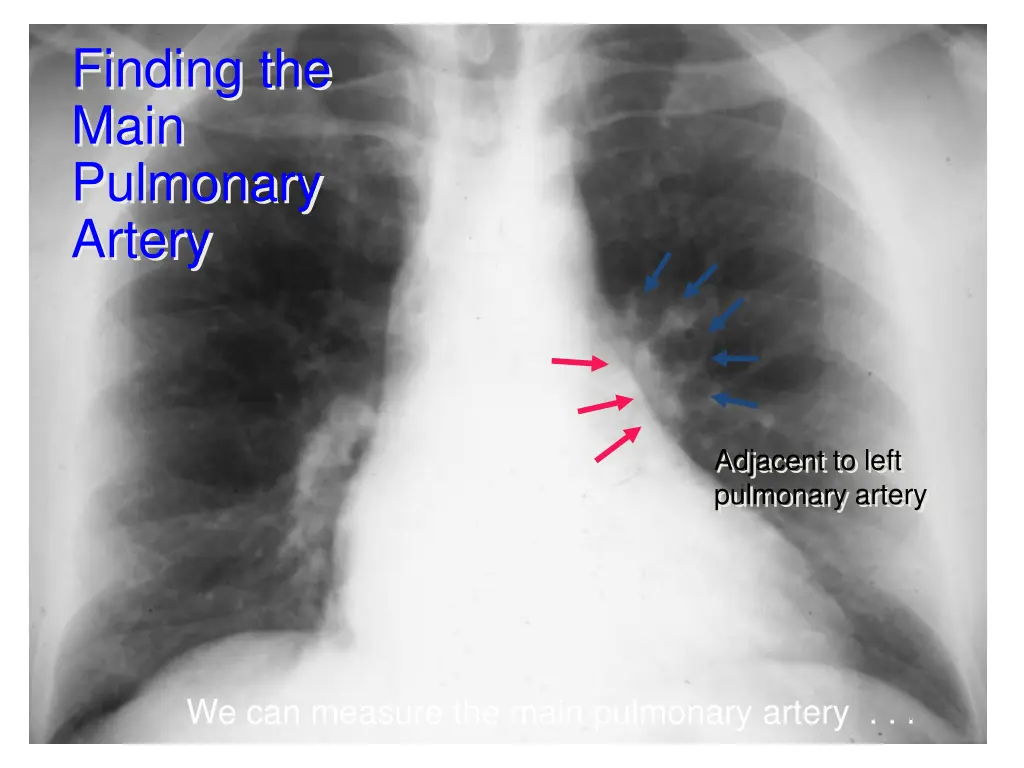 finding the main pulmonary artery 1