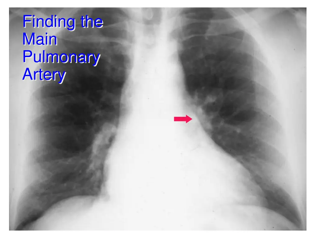 finding the main pulmonary artery