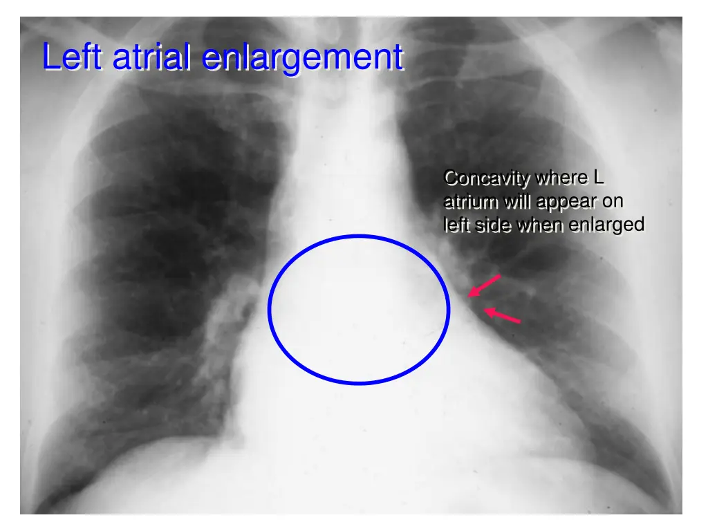 left atrial enlargement