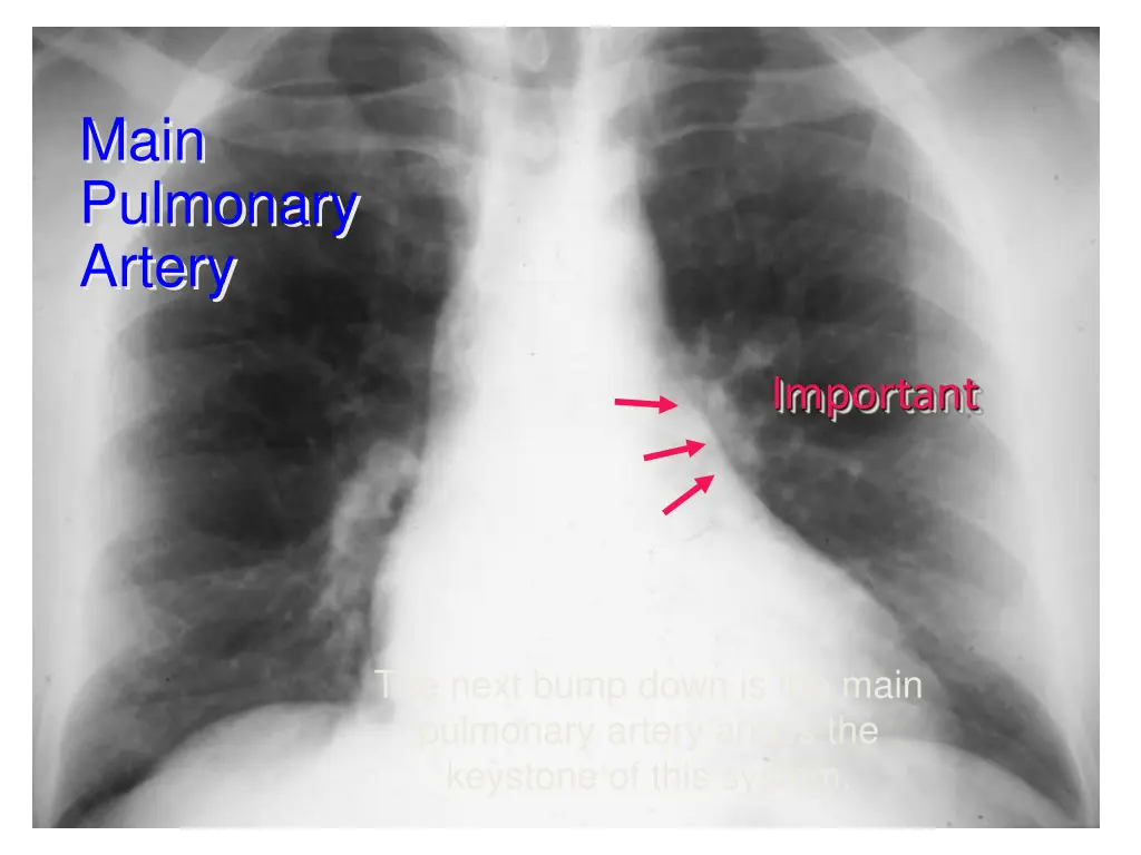 main pulmonary artery