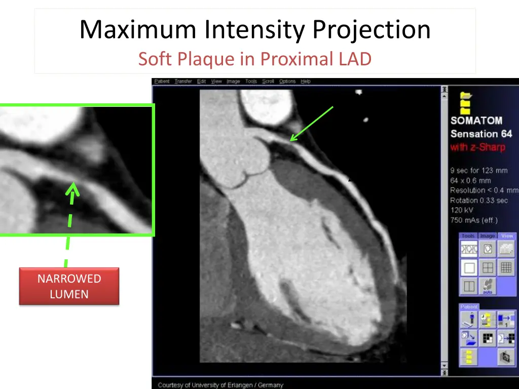 maximum intensity projection soft plaque