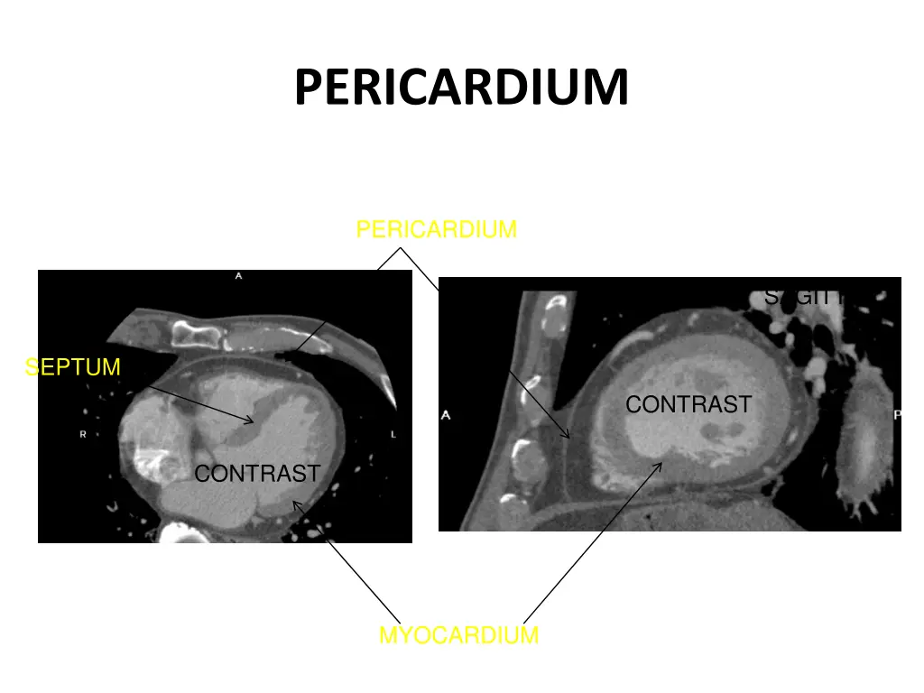 pericardium