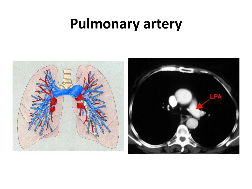 pulmonary artery