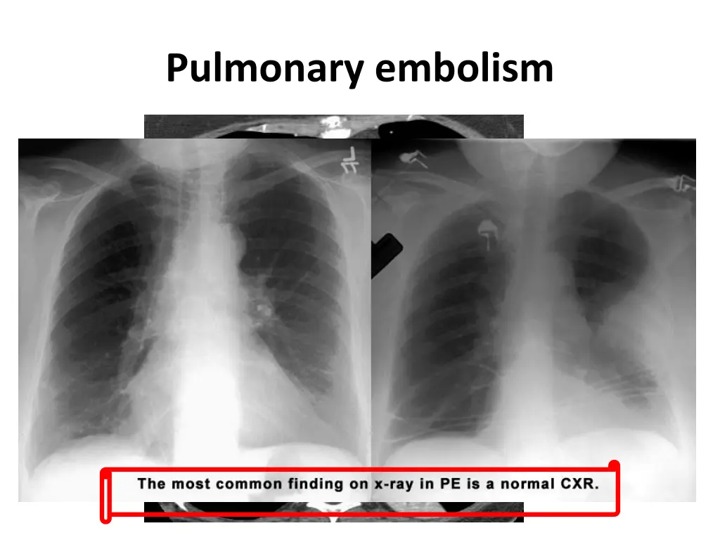 pulmonary embolism 1