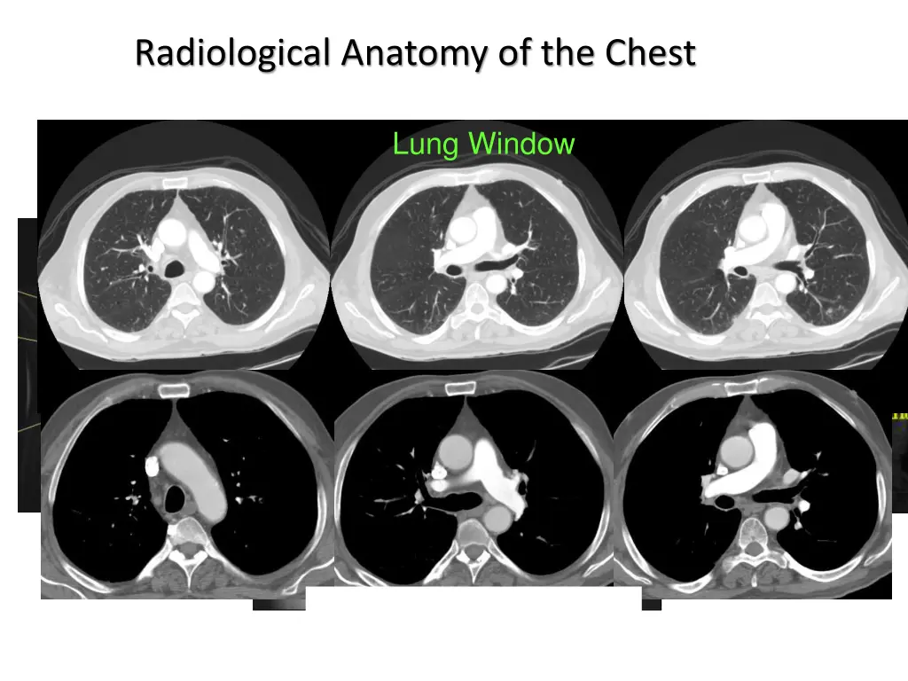 radiological anatomy of the chest