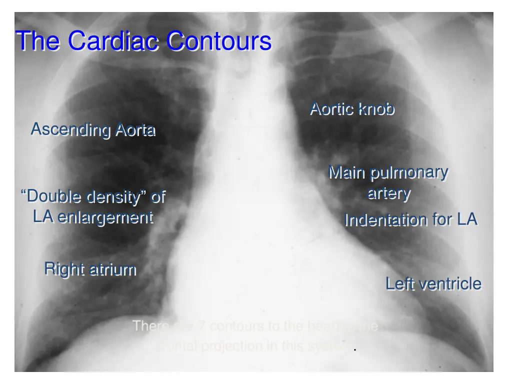 the cardiac contours