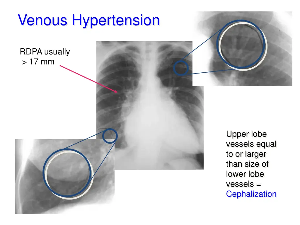 venous hypertension