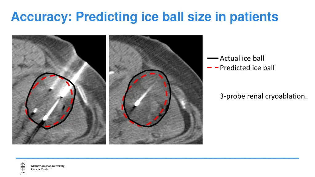 accuracy predicting ice ball size in patients