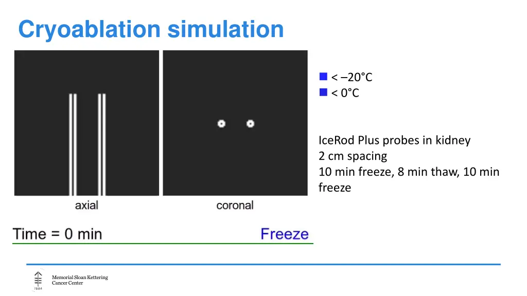 cryoablation simulation 1