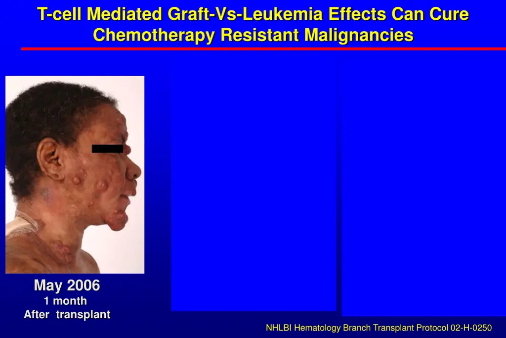 t cell mediated graft vs leukemia effects