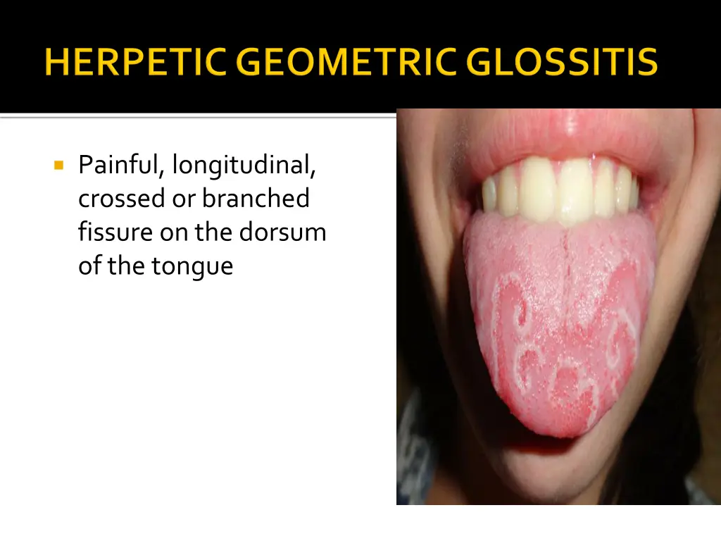 painful longitudinal crossed or branched fissure