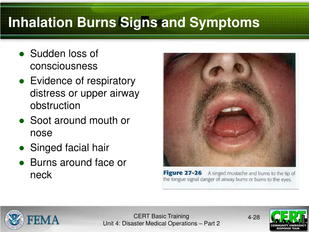 inhalation burns signs and symptoms