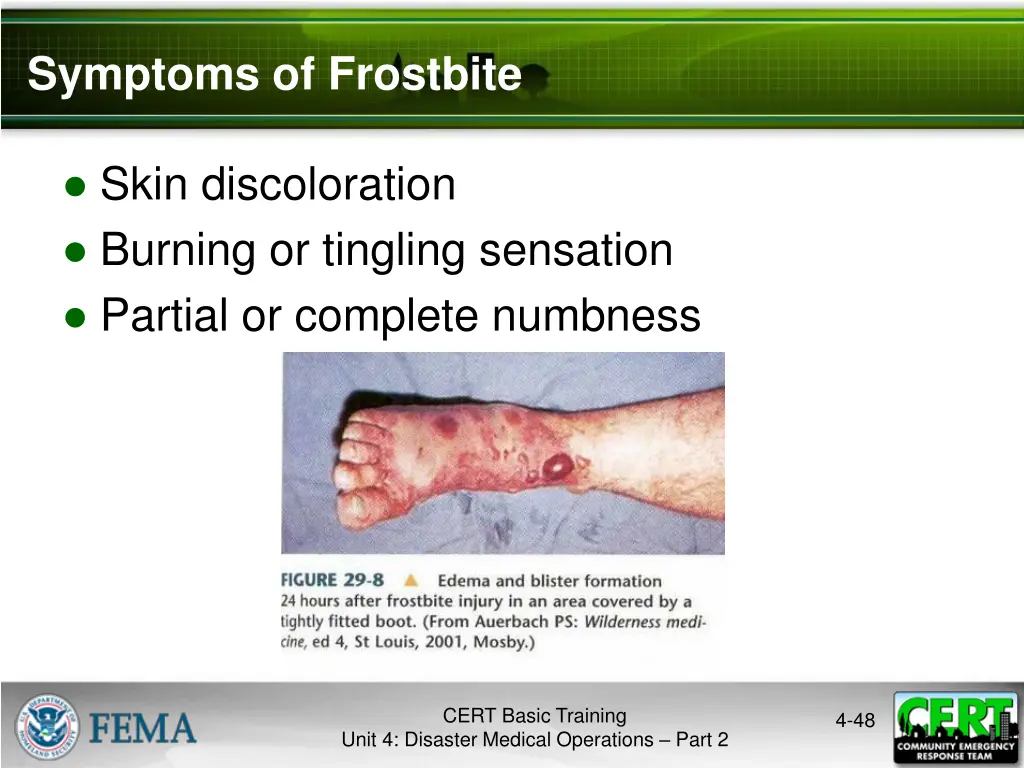 symptoms of frostbite