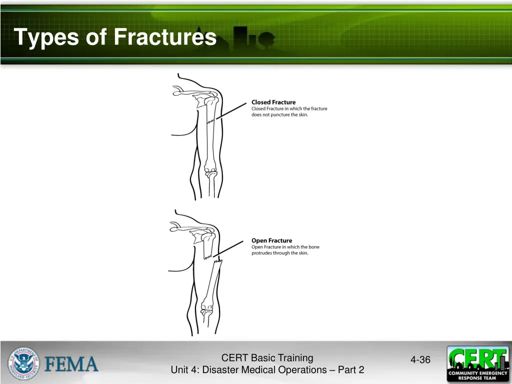 types of fractures