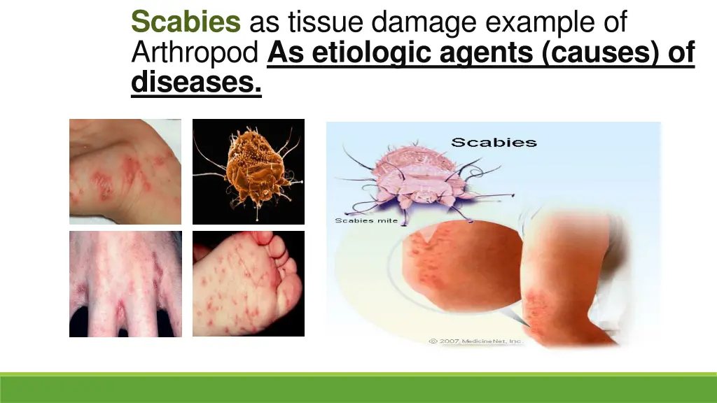 scabies as tissue damage example of arthropod