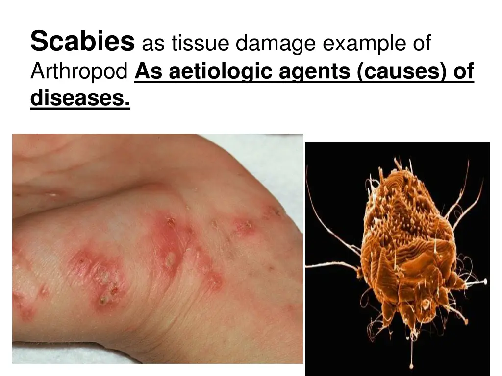 scabies as tissue damage example of arthropod