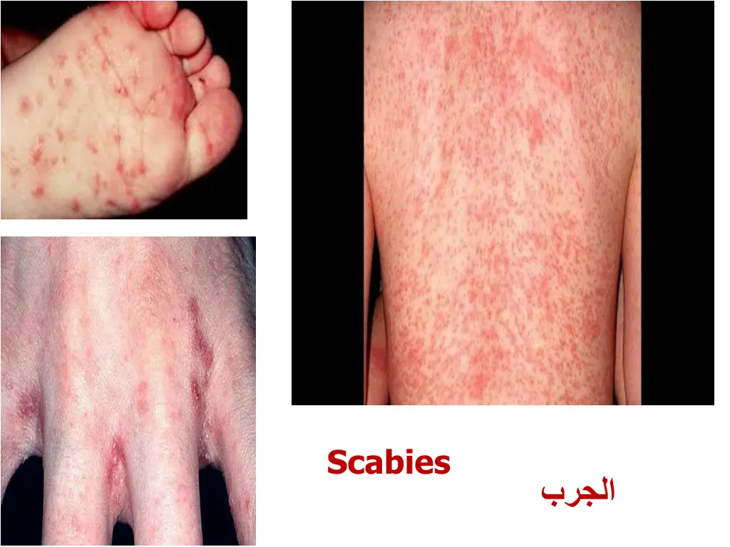 scabies