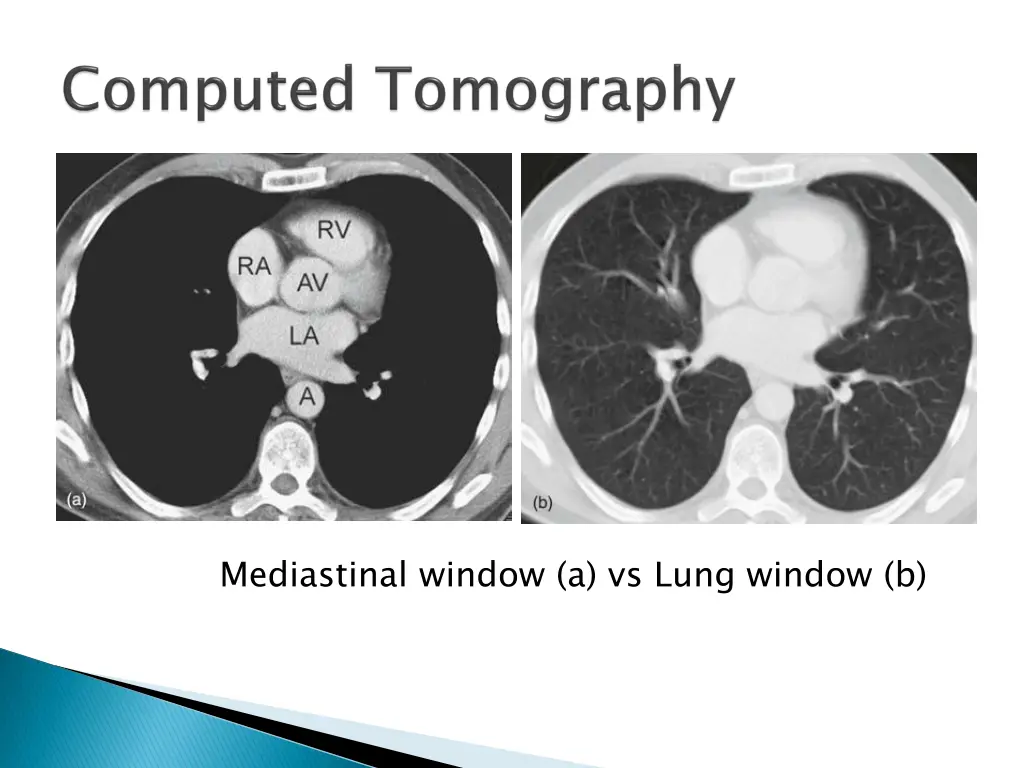 mediastinal window a vs lung window b