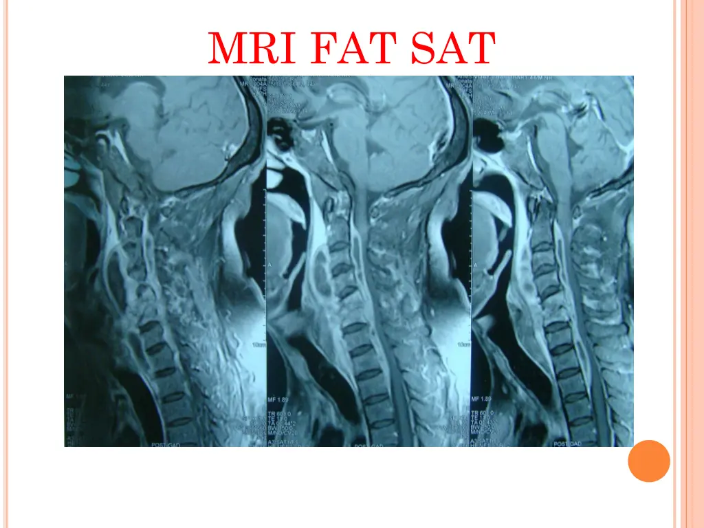 mri fat sat