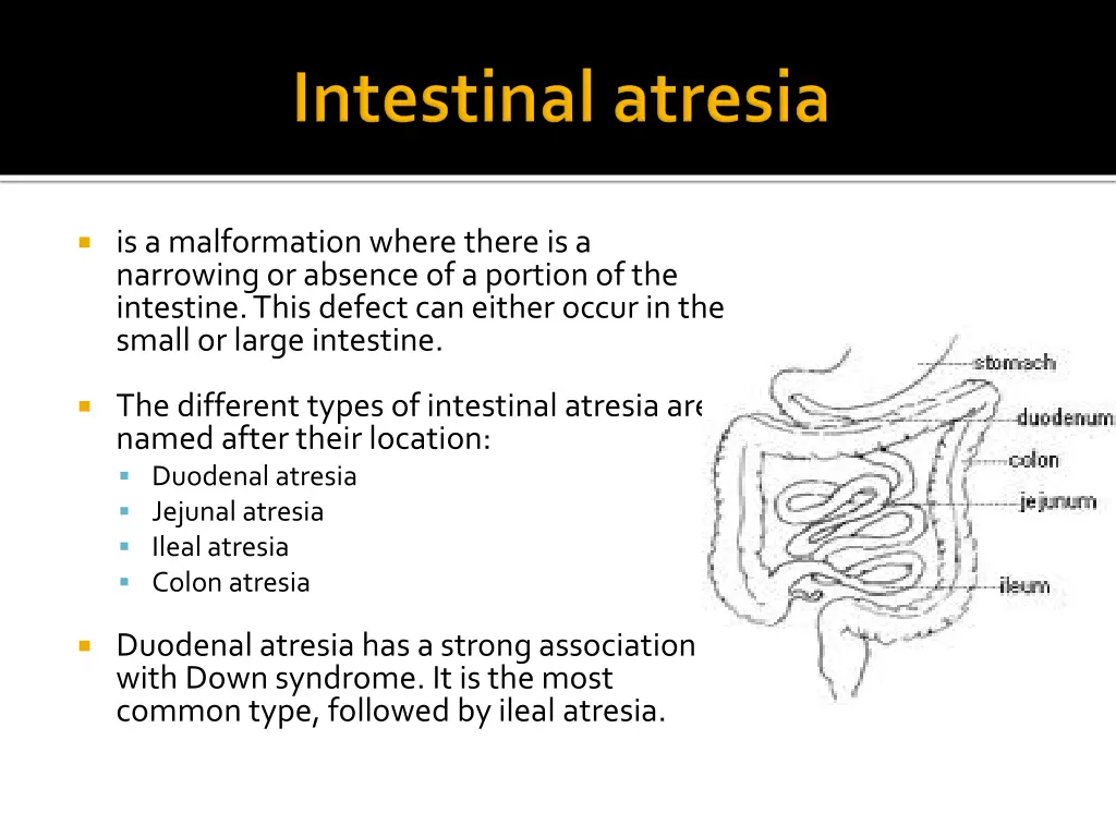 is a malformation where there is a narrowing