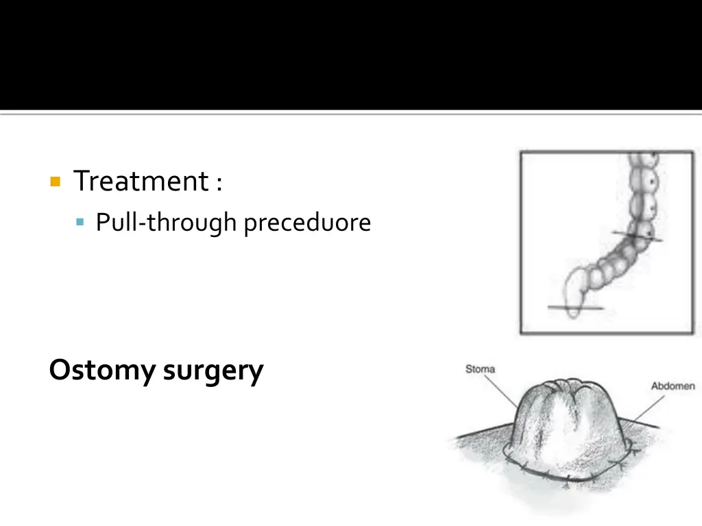 treatment pull through preceduore