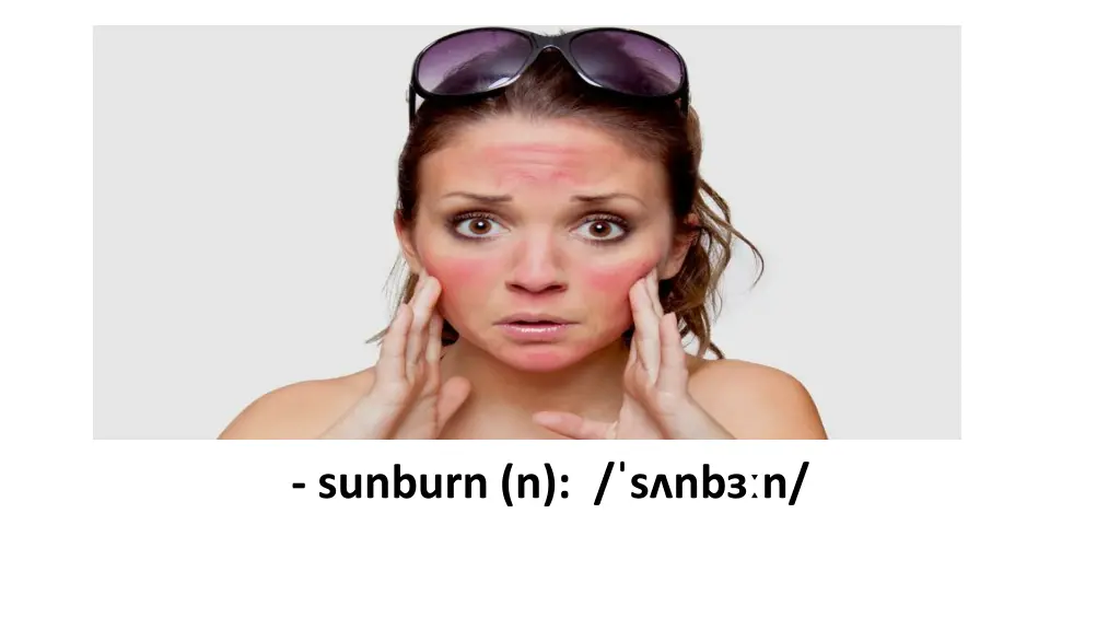 sunburn n s nb n