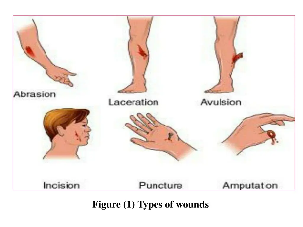 figure 1 types of wounds