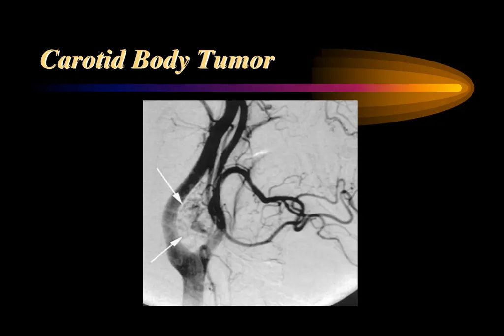 carotid body tumor 1