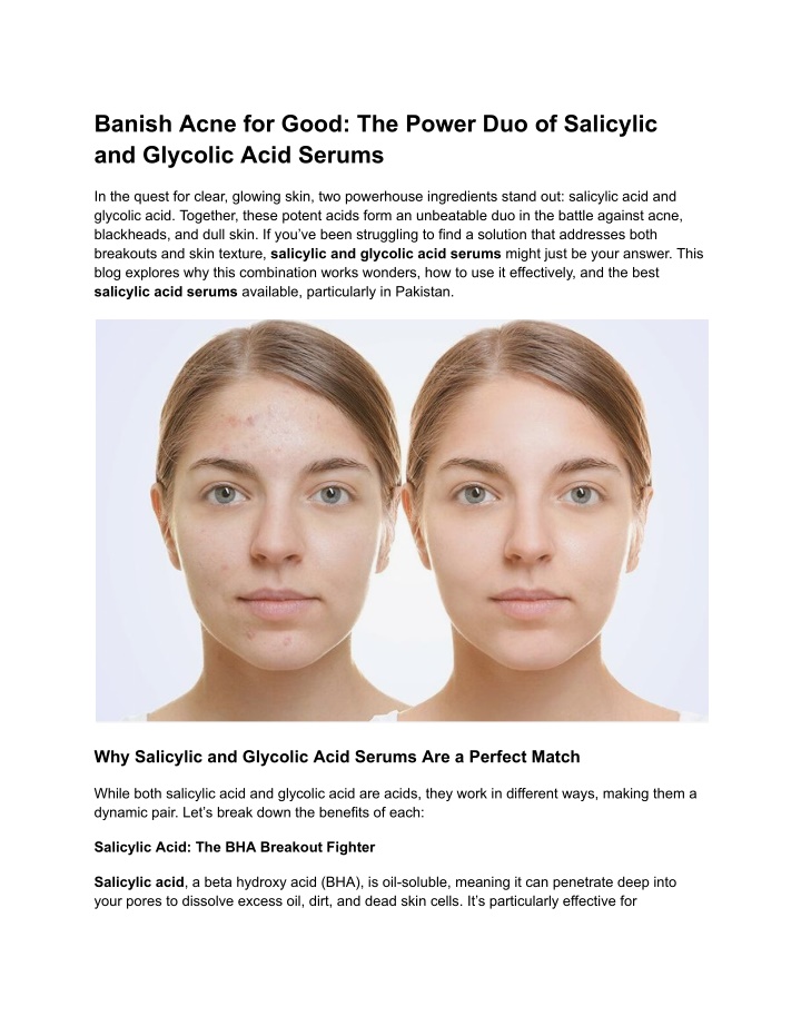 banish acne for good the power duo of salicylic