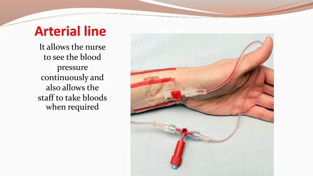 arterial line it allows the nurse