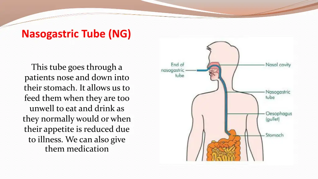 nasogastric tube ng