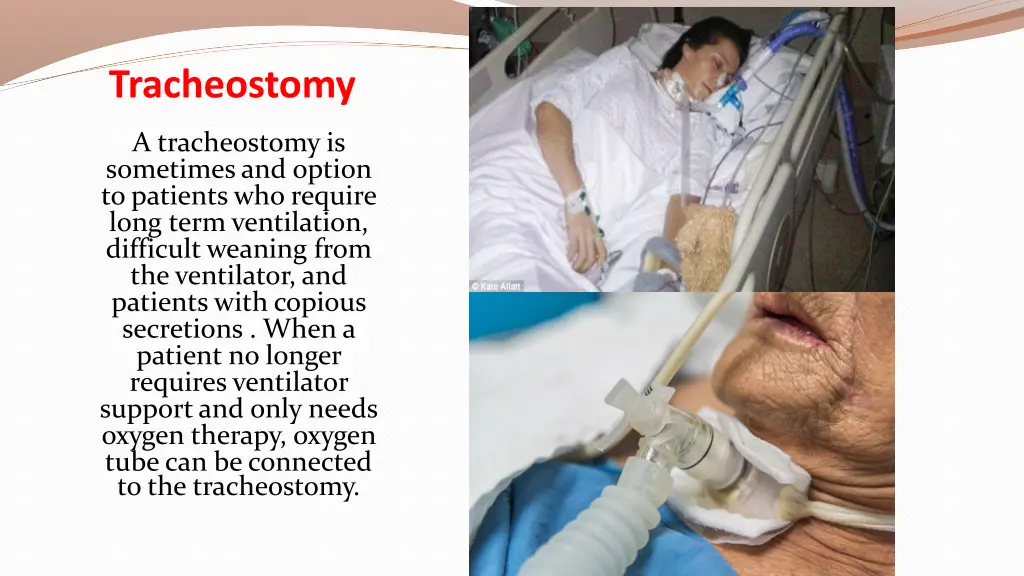 tracheostomy