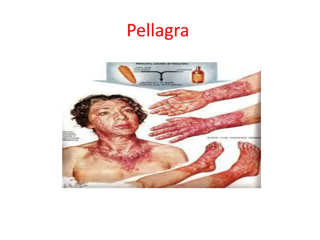 pellagra