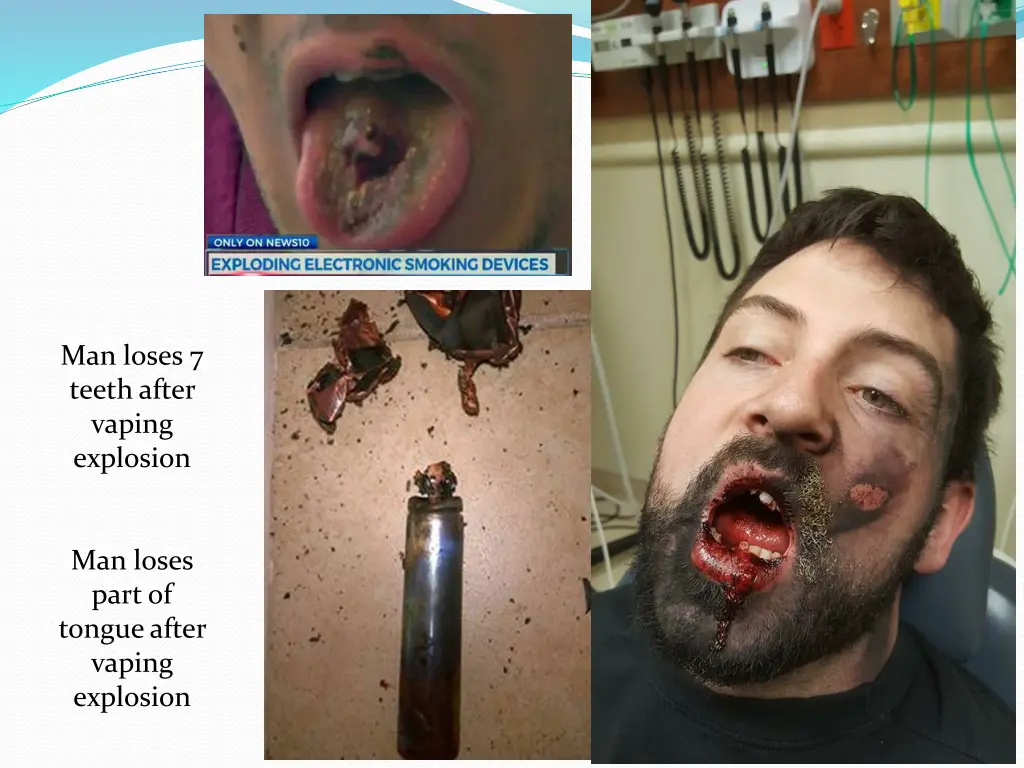 man loses 7 teeth after vaping explosion