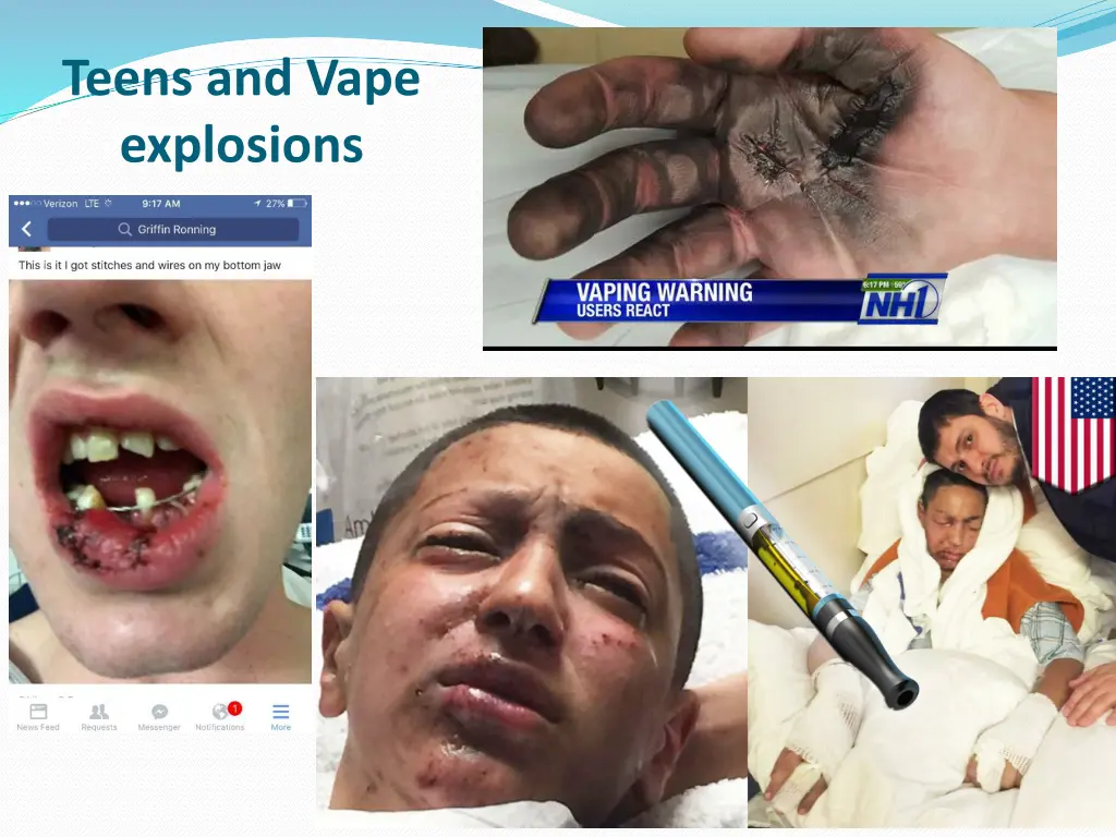 teens and vape explosions