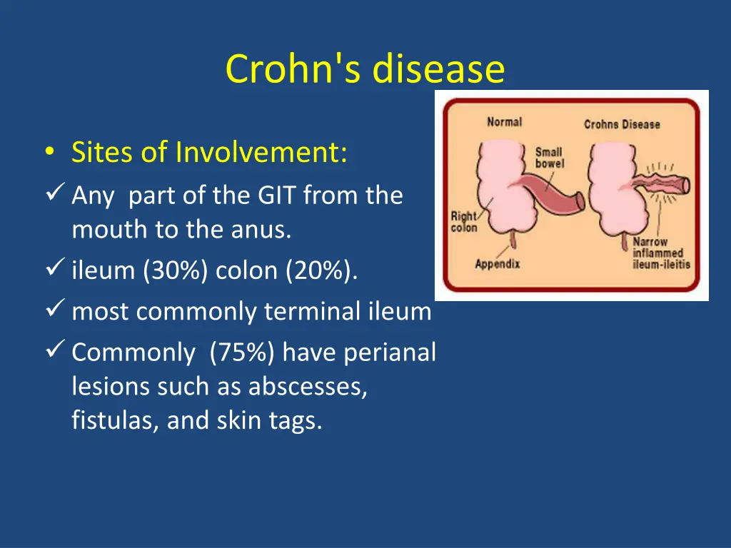 crohn s disease 2