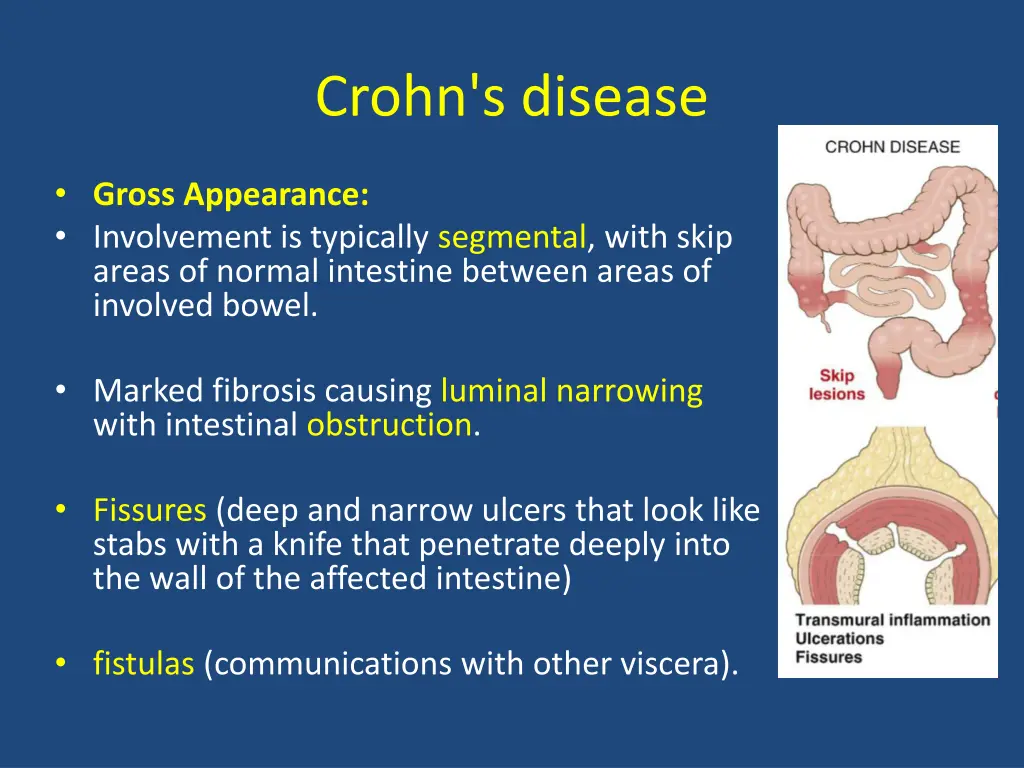 crohn s disease 3