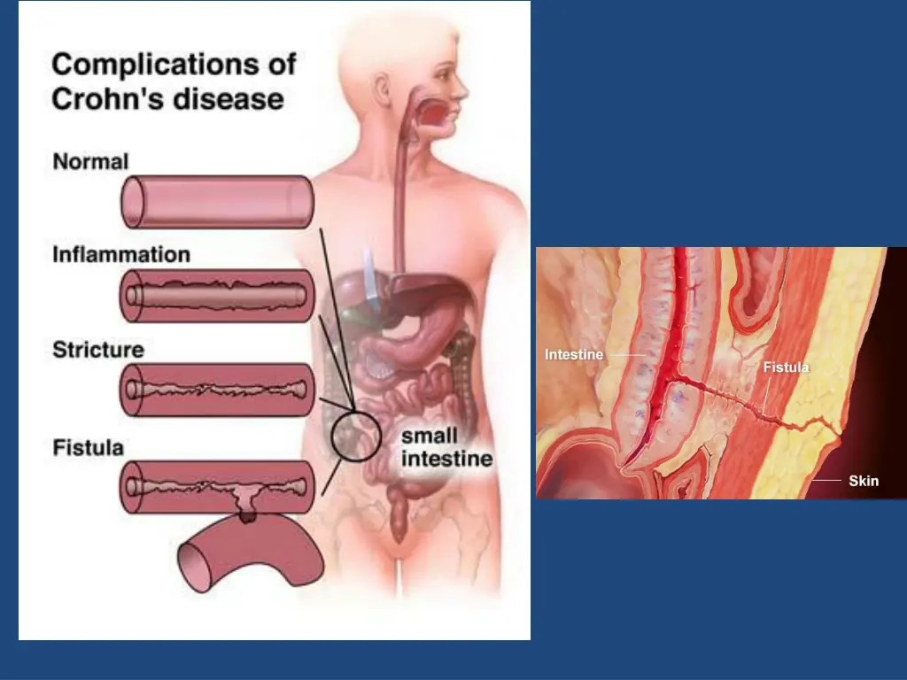 crohn s disease 6