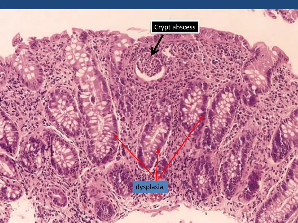 crypt abscess