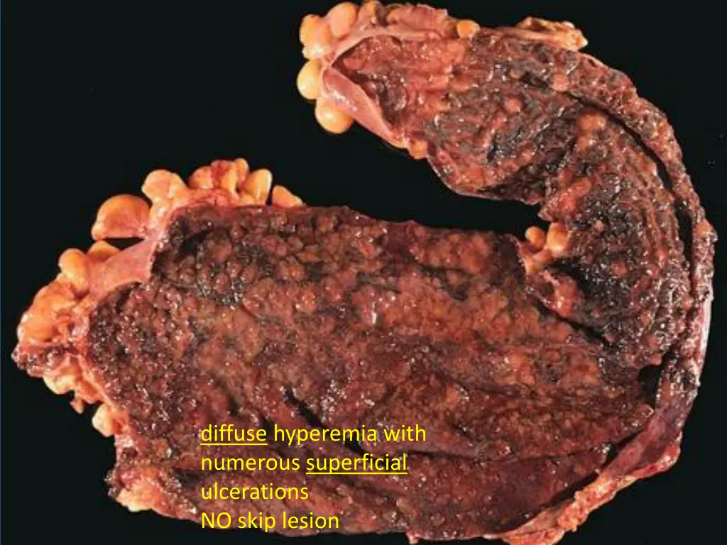 diffuse hyperemia with numerous superficial