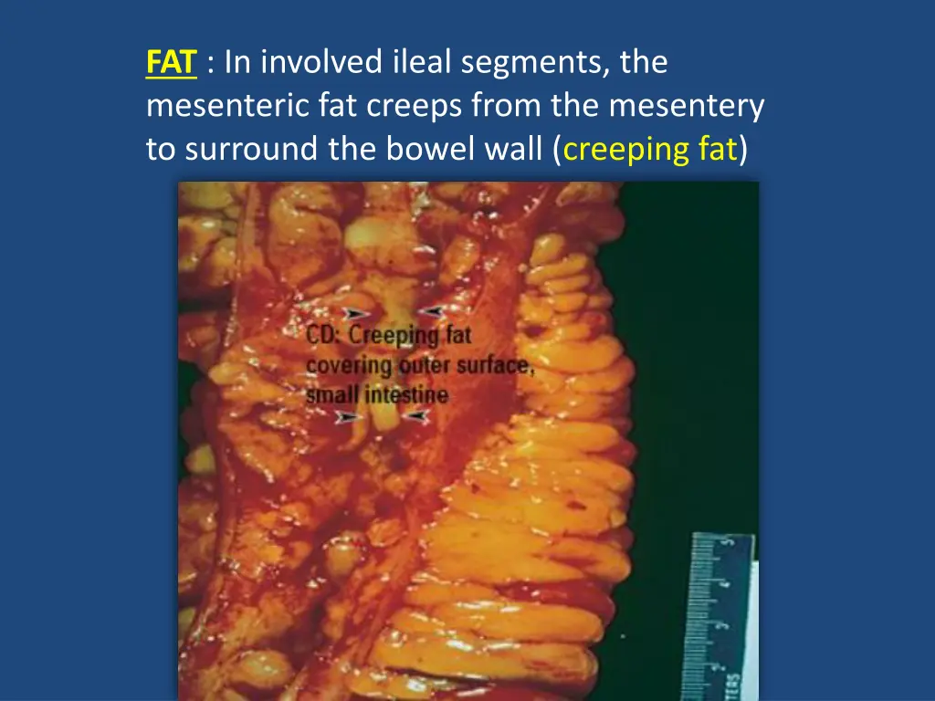 fat in involved ileal segments the mesenteric