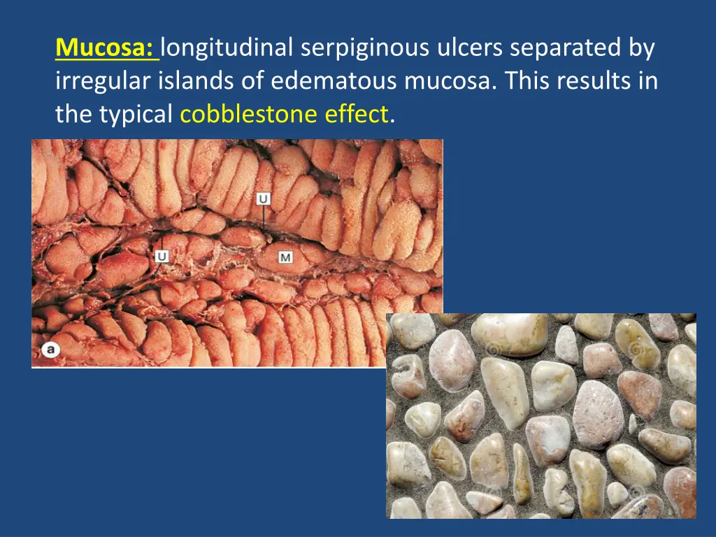 mucosa longitudinal serpiginous ulcers separated