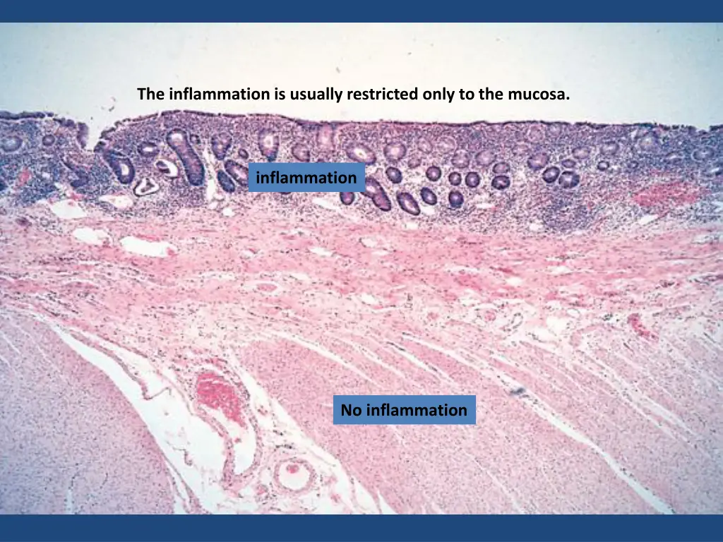 the inflammation is usually restricted only