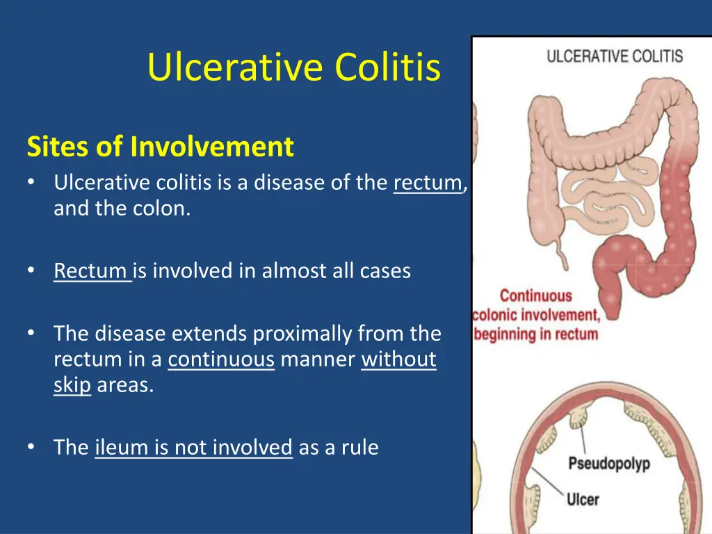 ulcerative colitis 3