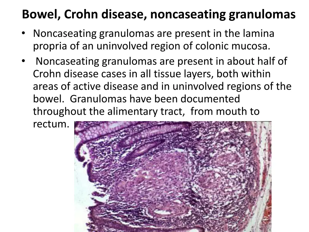 bowel crohn disease noncaseating granulomas