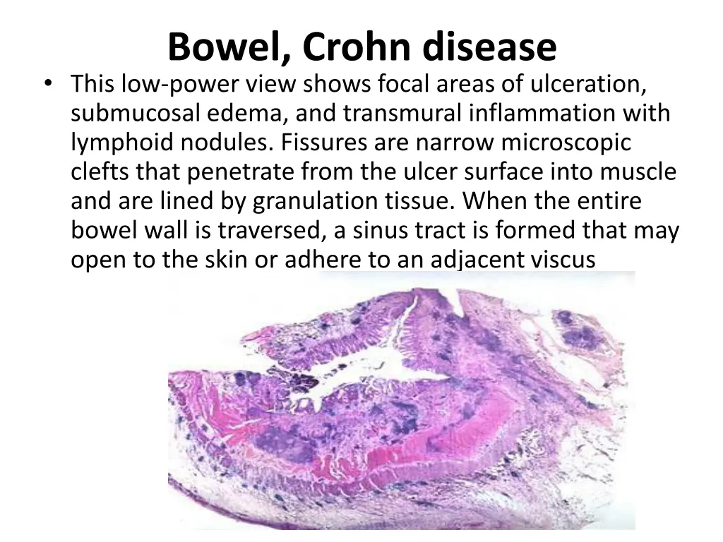 bowel crohn disease this low power view shows