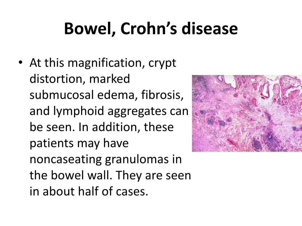 bowel crohn s disease